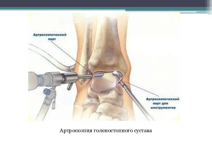 Артроскопия голеностопного сустава