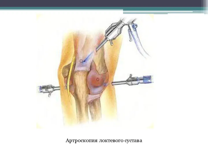 Артроскопия локтевого сустава