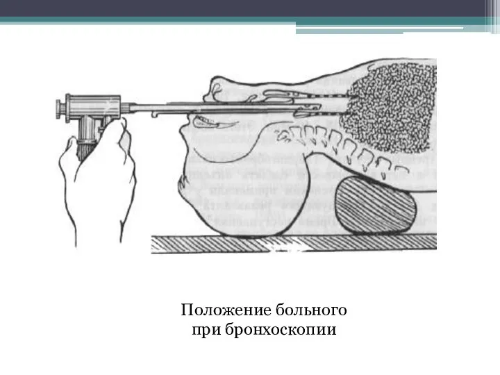 Положение больного при бронхоскопии