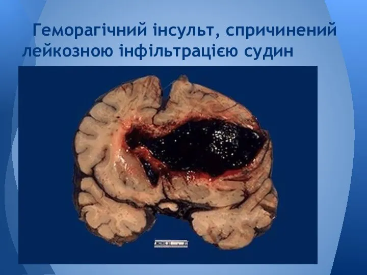 Геморагічний інсульт, спричинений лейкозною інфільтрацією судин