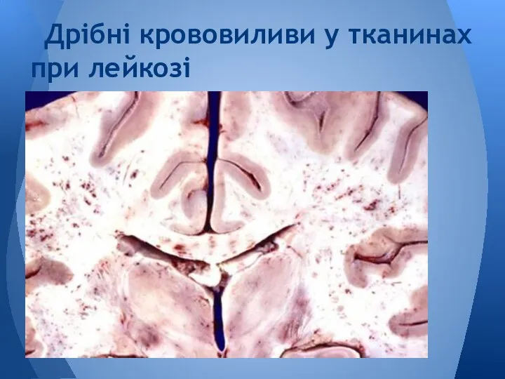 Дрібні крововиливи у тканинах при лейкозі