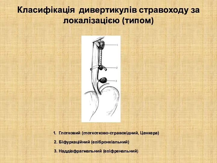 Класифікація дивертикулів стравоходу за локалізацією (типом) 1. Глотковий (глоткотково-стравохідний, Ценкера) 2. Біфуркаційний (епібронхіальний) 3. Наддіафрагмальний (епіфренальний)