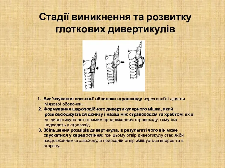 Стадії виникнення та розвитку глоткових дивертикулів 1. Вип’ячування слизової оболонки стравоходу