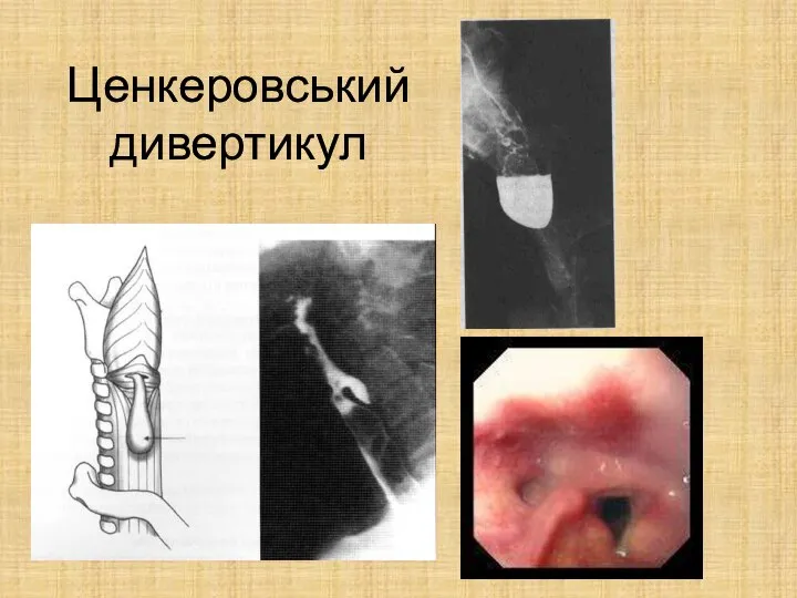 Ценкеровський дивертикул