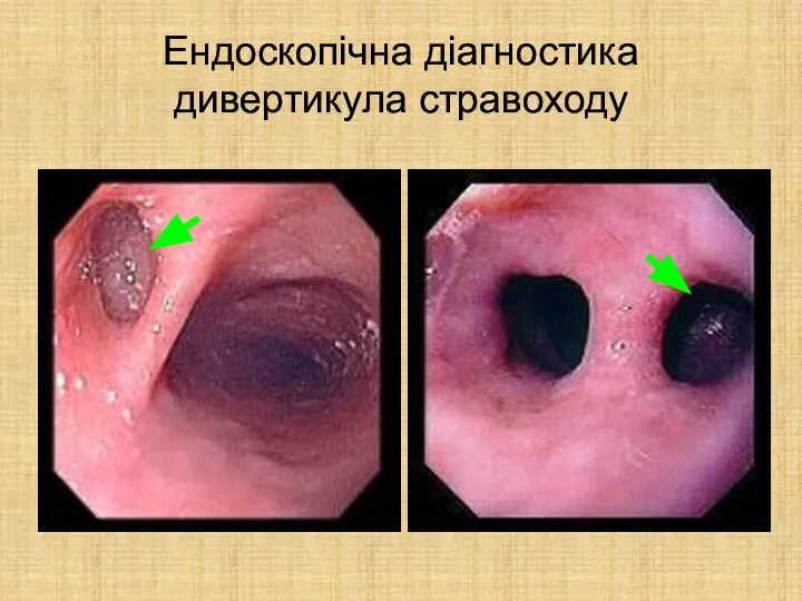 Ендоскопічна діагностика дивертикула стравоходу