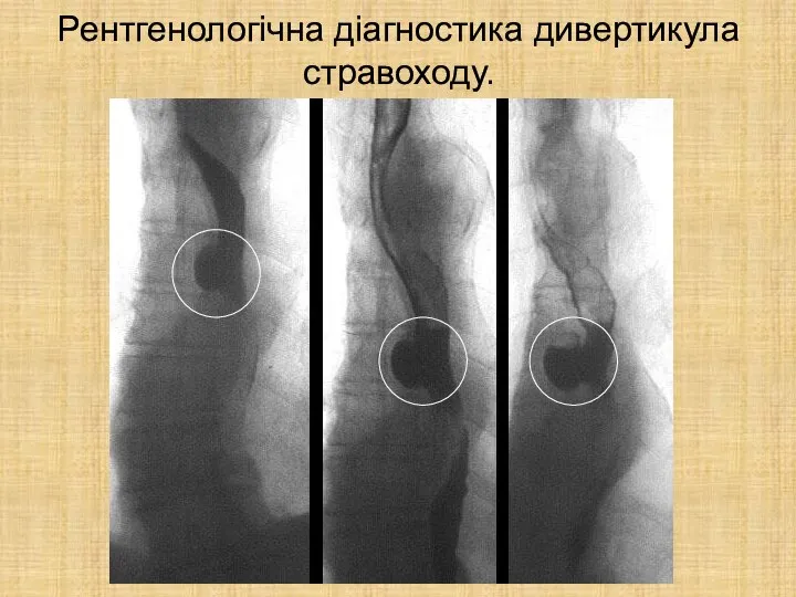 Рентгенологічна діагностика дивертикула стравоходу.