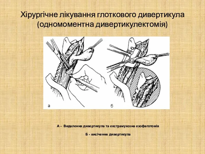 Хірургічне лікування глоткового дивертикула (одномоментна дивертикулектомія) А - Видалення дивертикула та