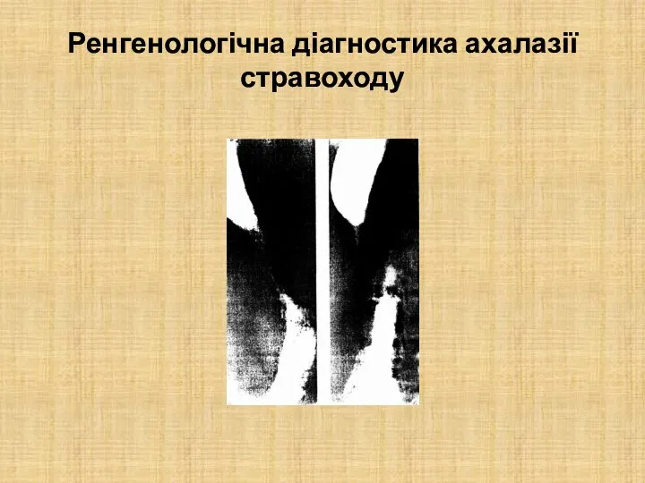 Ренгенологічна діагностика ахалазії стравоходу