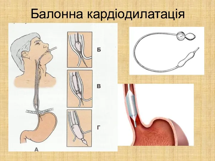 Балонна кардіодилатація