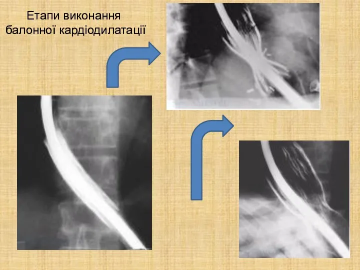Етапи виконання балонної кардіодилатації