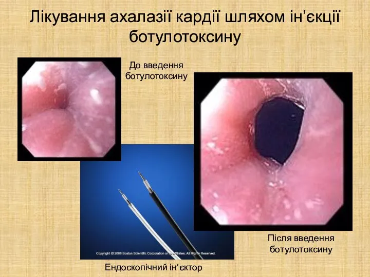 Лікування ахалазії кардії шляхом ін’єкції ботулотоксину До введення ботулотоксину Після введення ботулотоксину Ендоскопічний ін’єктор