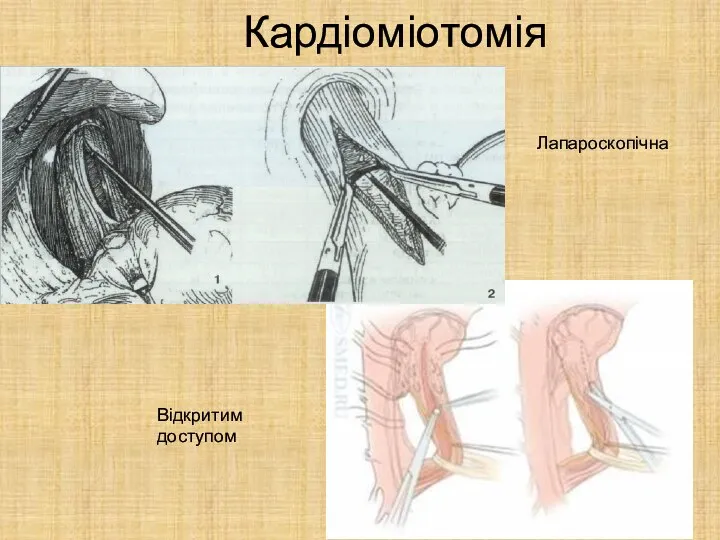 Кардіоміотомія Лапароскопічна Відкритим доступом