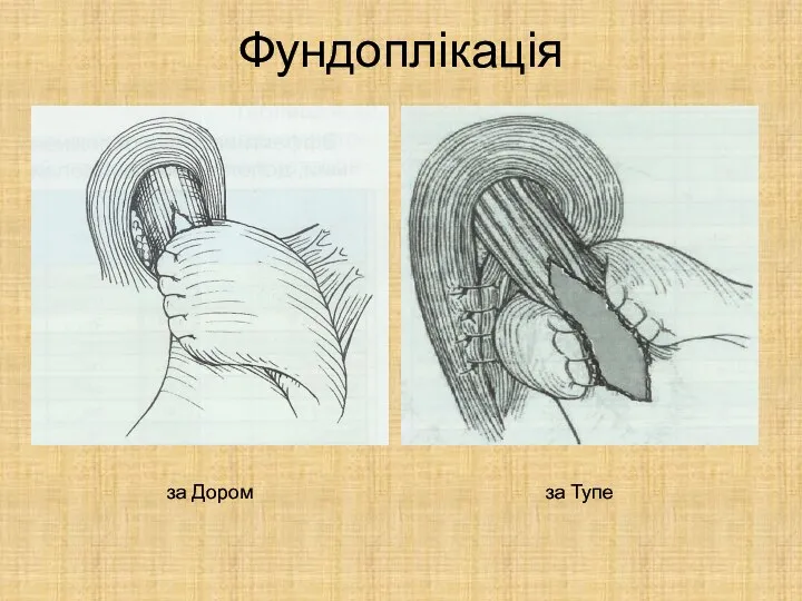 Фундоплікація за Дором за Тупе