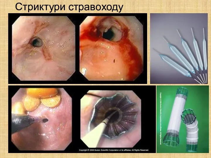 Стриктури стравоходу