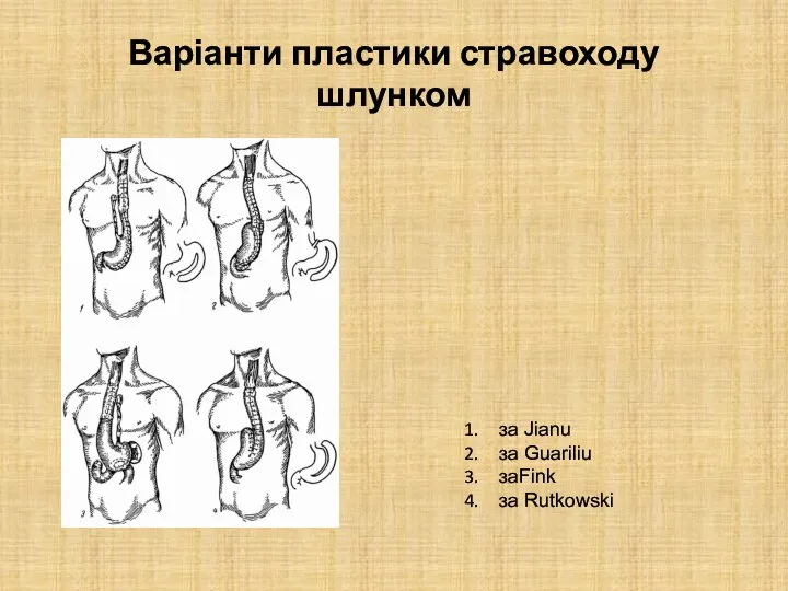 Варіанти пластики стравоходу шлунком за Jianu за Guariliu заFink за Rutkowski