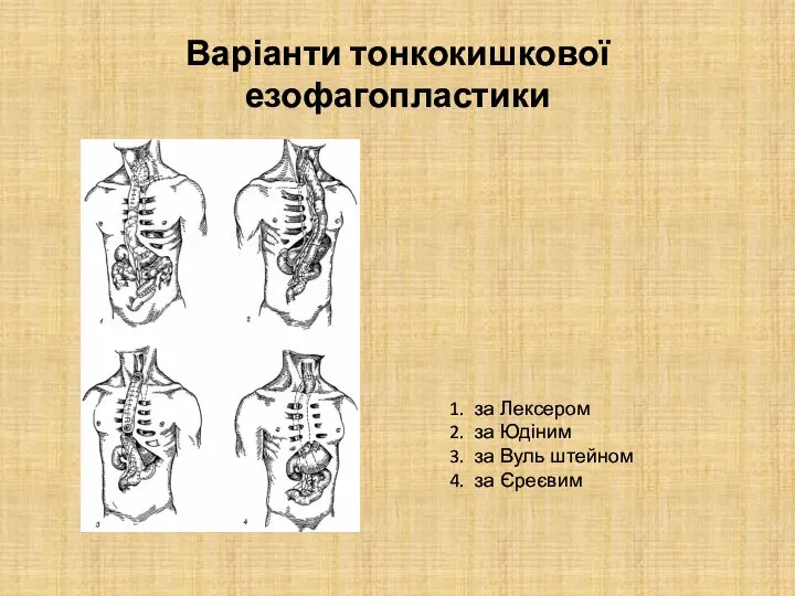 Варіанти тонкокишкової езофагопластики за Лексером за Юдіним за Вуль штейном за Єреєвим