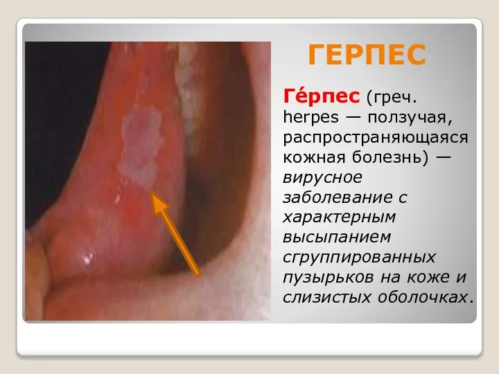 ГЕРПЕС Ге́рпес (греч. herpes — ползучая, распространяющаяся кожная болезнь) — вирусное