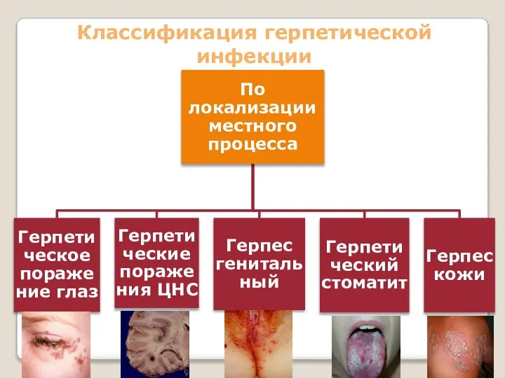 Классификация герпетической инфекции