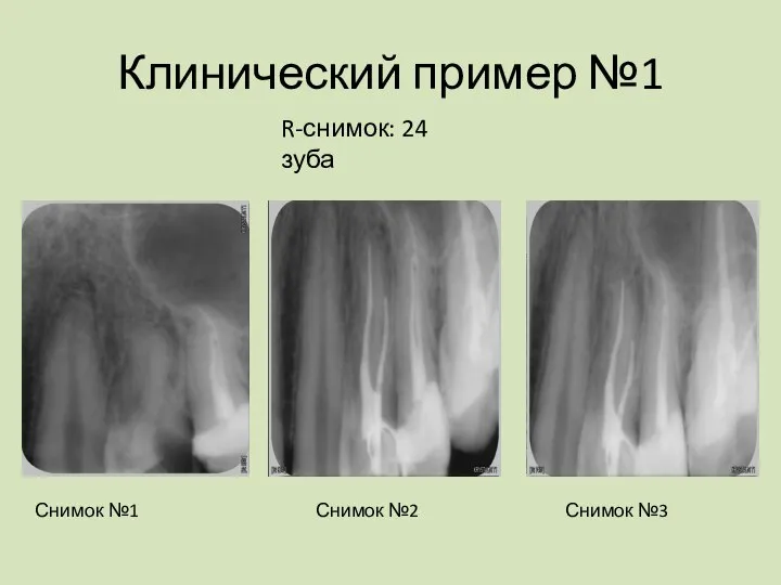 Клинический пример №1 R-снимок: 24 зуба Снимок №1 Снимок №2 Снимок №3