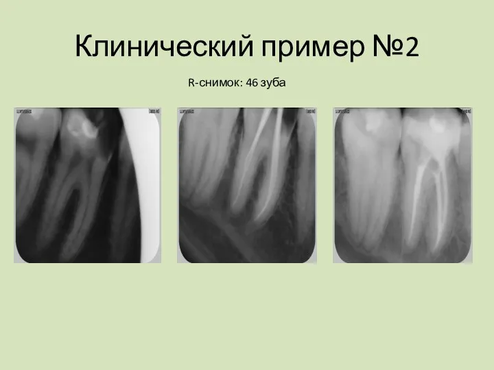 Клинический пример №2 R-снимок: 46 зуба