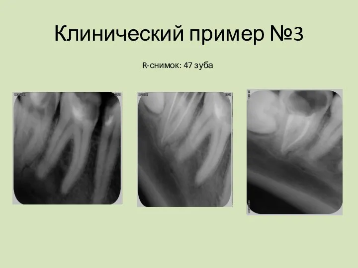 Клинический пример №3 R-снимок: 47 зуба