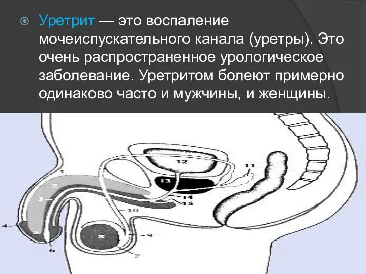 Уретрит — это воспаление мочеиспускательного канала (уретры). Это очень распространенное урологическое