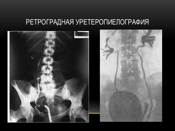 РЕТРОГРАДНАЯ УРЕТЕРОПИЕЛОГРАФИЯ