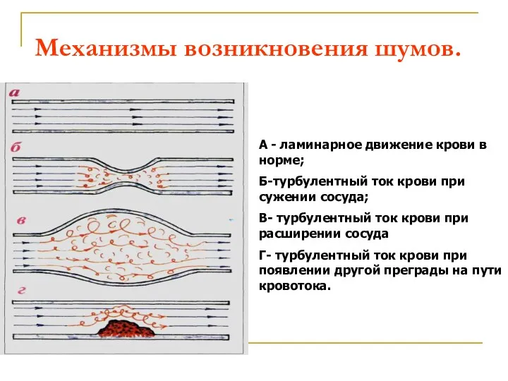 Механизмы возникновения шумов. А - ламинарное движение крови в норме; Б-турбулентный