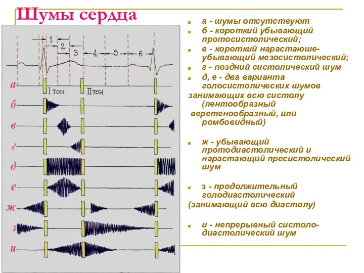 Шумы сердца а - шумы отсутствуют б - короткий убывающий протосистолический;