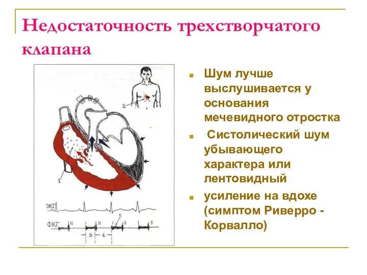 Недостаточность трехстворчатого клапана Шум лучше выслушивается у основания мечевидного отростка Систолический