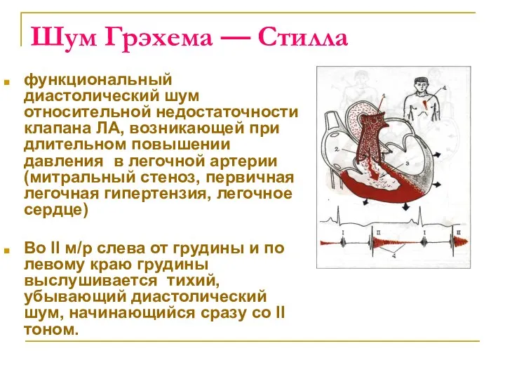 Шум Грэхема — Стилла функциональный диастолический шум относительной недостаточности клапана ЛА,