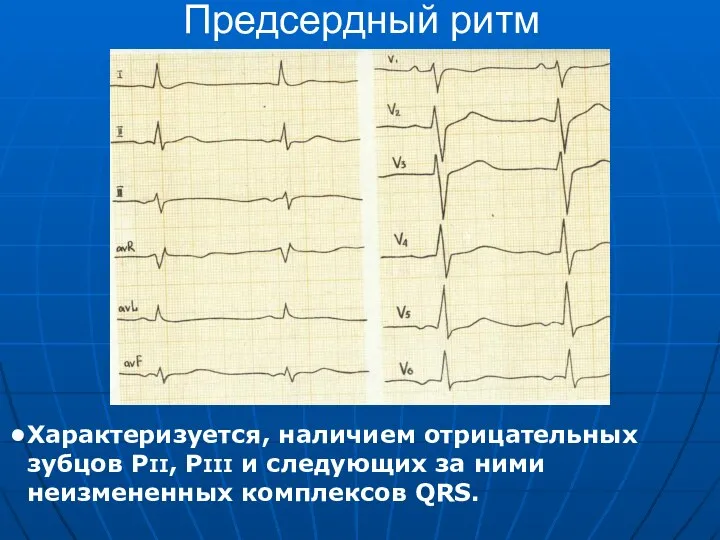 Предсердный ритм Характеризуется, наличием отрицательных зубцов РII, РIII и следующих за ними неизмененных комплексов QRS.