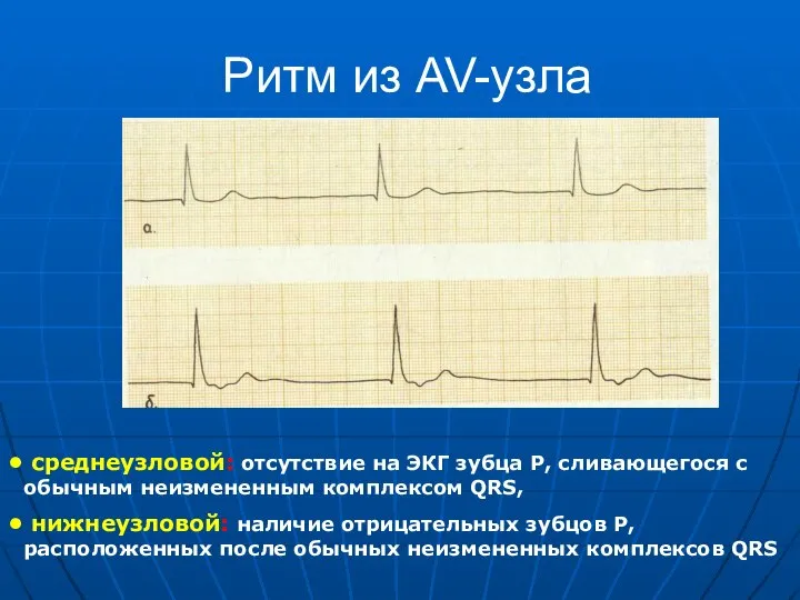 Ритм из AV-узла среднеузловой: отсутствие на ЭКГ зубца Р, сливающегося с