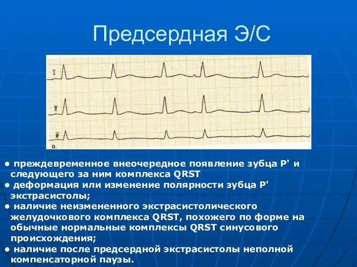 Предсердная Э/С преждевременное внеочередное появление зубца Р' и следующего за ним