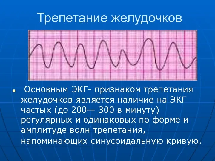 Трепетание желудочков Основным ЭКГ- признаком трепетания желудочков является наличие на ЭКГ