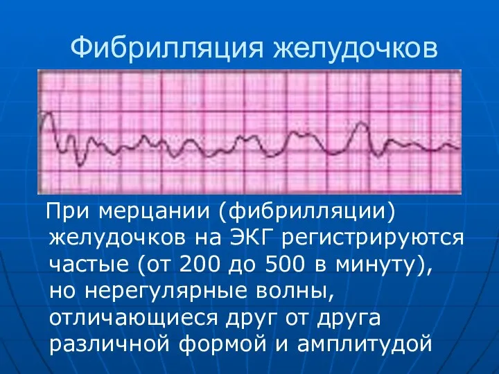 Фибрилляция желудочков При мерцании (фибрилляции) желудочков на ЭКГ регистрируются частые (от