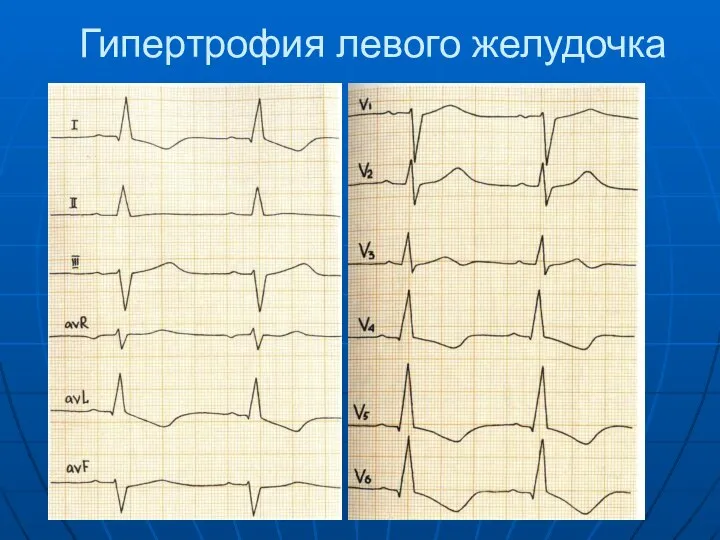 Гипертрофия левого желудочка