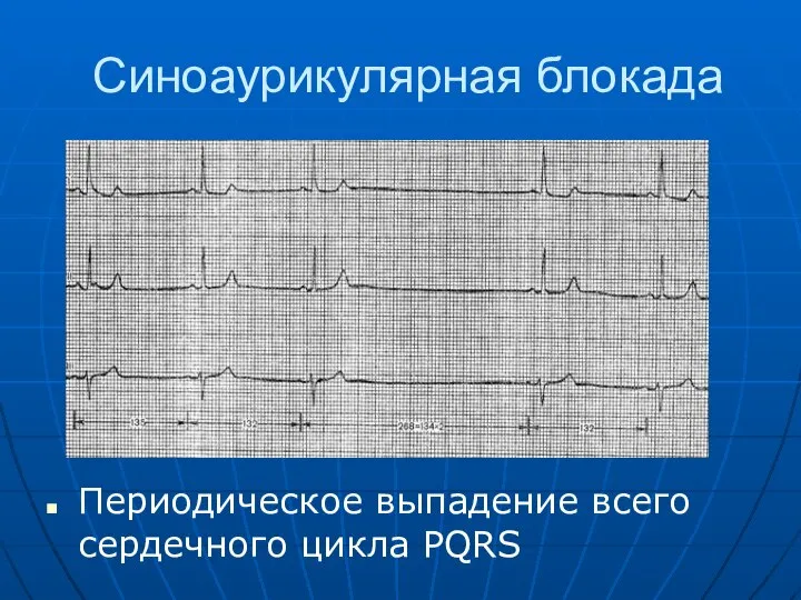 Синоаурикулярная блокада Периодическое выпадение всего сердечного цикла PQRS