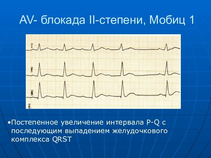 AV- блокада II-степени, Мобиц 1 Постепенное увеличение интервала P-Q c последующим выпадением желудочкового комплекса QRST