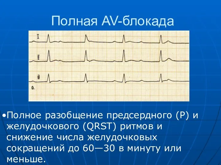 Полная AV-блокада Полное разобщение предсердного (Р) и желудочкового (QRST) ритмов и