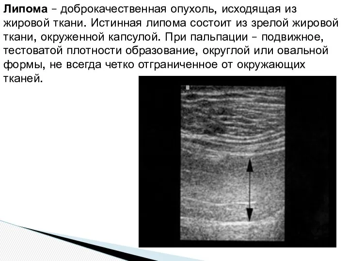 Липома – доброкачественная опухоль, исходящая из жировой ткани. Истинная липома состоит