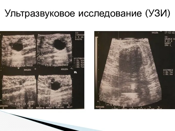 Ультразвуковое исследование (УЗИ)