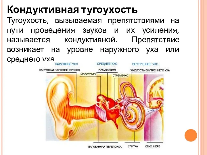 Кондуктивная тугоухость Тугоухость, вызываемая препятствиями на пути проведения звуков и их