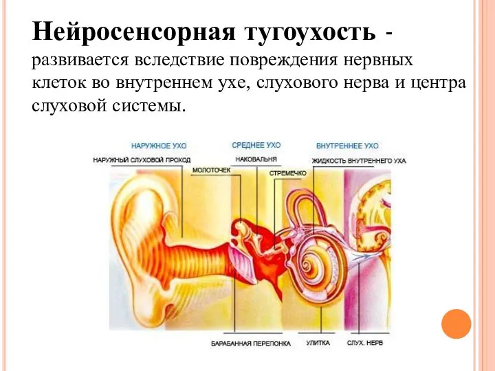 Нейросенсорная тугоухость - развивается вследствие повреждения нервных клеток во внутреннем ухе,