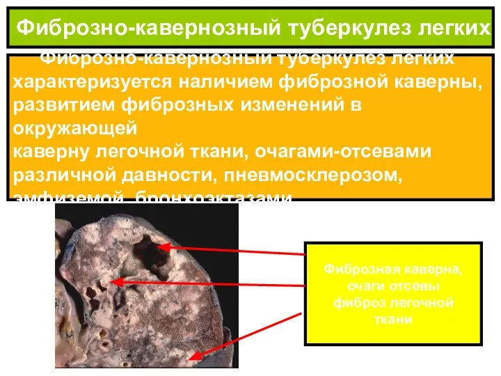 Фиброзно-кавернозный туберкулез легких характеризуется наличием фиброзной каверны, развитием фиброзных изменений в