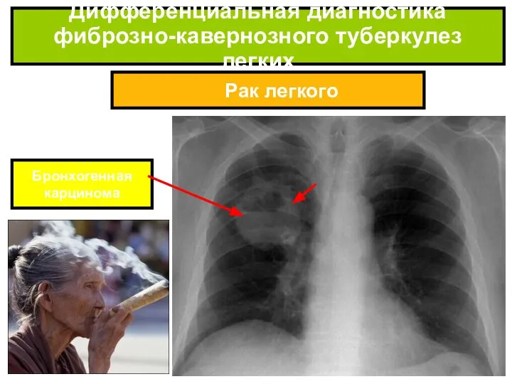Рак легкого Дифференциальная диагностика фиброзно-кавернозного туберкулез легких Бронхогенная карцинома