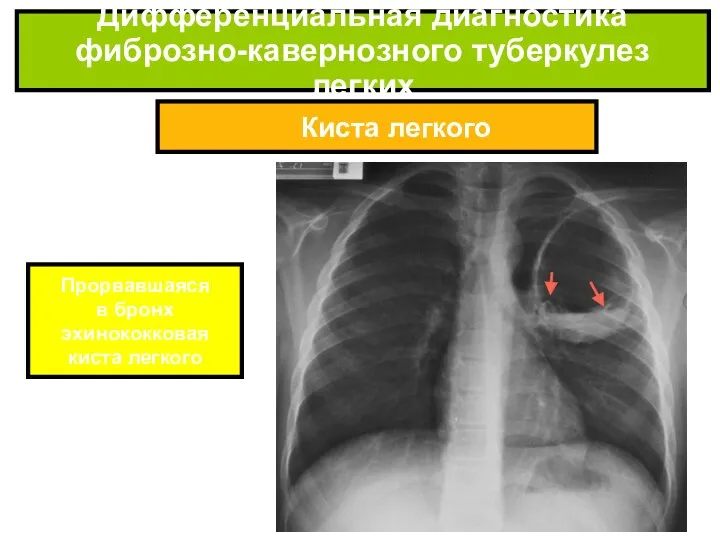Киста легкого Дифференциальная диагностика фиброзно-кавернозного туберкулез легких Прорвавшаяся в бронх эхинококковая киста легкого
