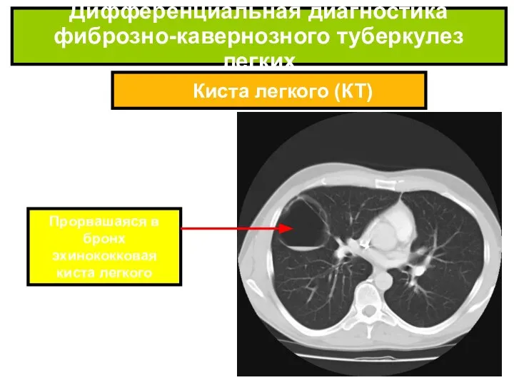 Киста легкого (КТ) Дифференциальная диагностика фиброзно-кавернозного туберкулез легких Прорвашаяся в бронх эхинококковая киста легкого