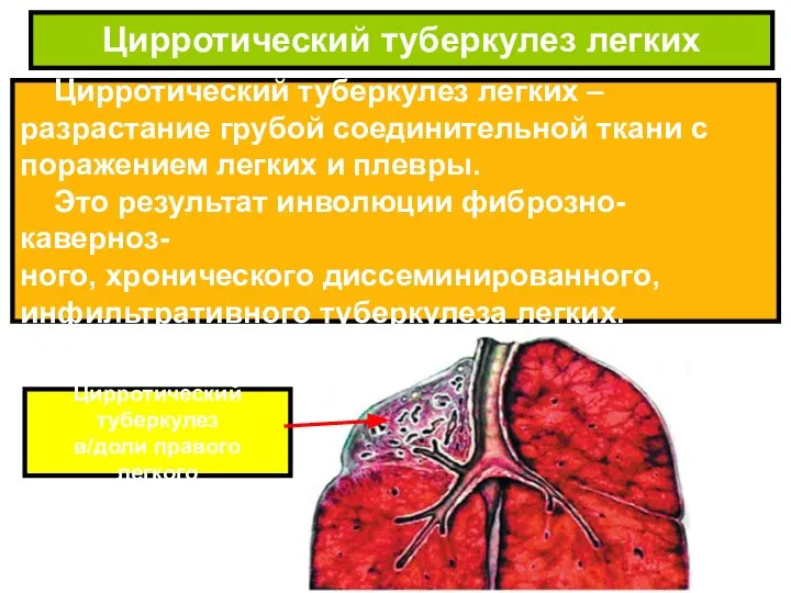 Цирротический туберкулез легких – разрастание грубой соединительной ткани с поражением легких