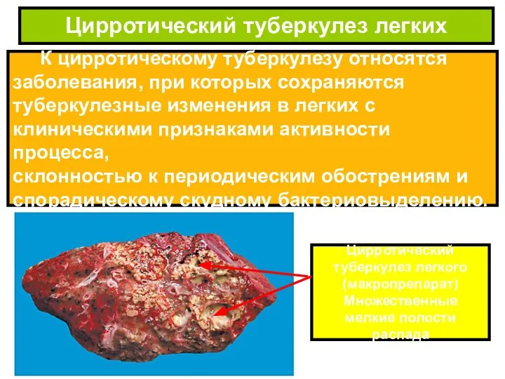 К цирротическому туберкулезу относятся заболевания, при которых сохраняются туберкулезные изменения в